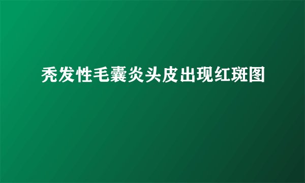 秃发性毛囊炎头皮出现红斑图