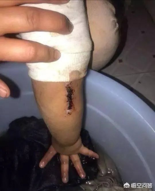泉州11岁女孩疑似遭后妈毒打,伤痕累累, 你怎么看?