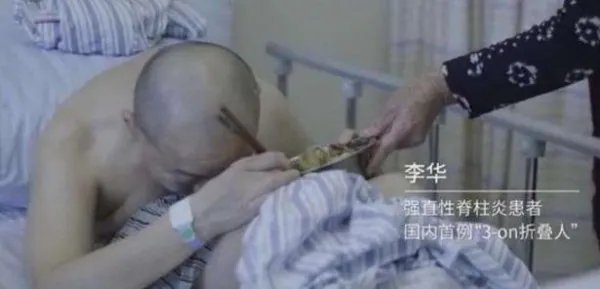 那个感动全国,被称作“折叠人”的李华,4次手术后现状怎样?