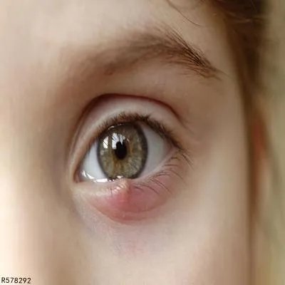 眼疖子怎么去掉 去掉眼疖子的几个方法详述