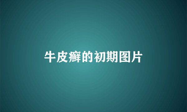牛皮癣的初期图片