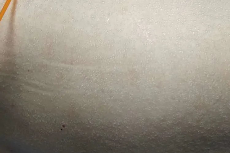大人痱子症状图片