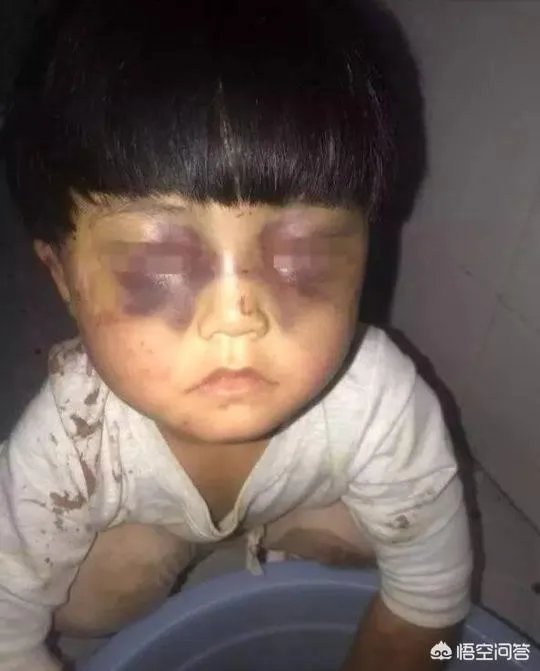 泉州11岁女孩疑似遭后妈毒打,伤痕累累, 你怎么看?