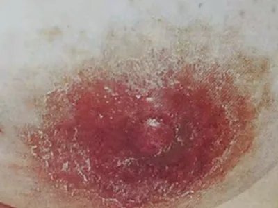 乳房湿疹样癌脱皮图片