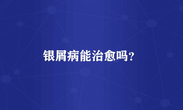 银屑病能治愈吗？