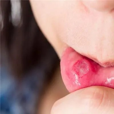 口腔溃疡吃什么好