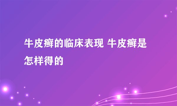 牛皮癣的临床表现 牛皮癣是怎样得的
