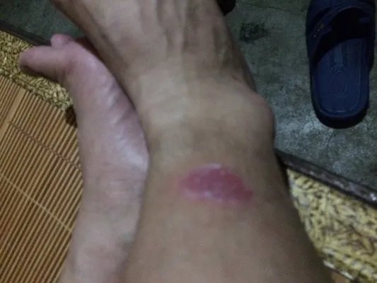 体癣的症状
