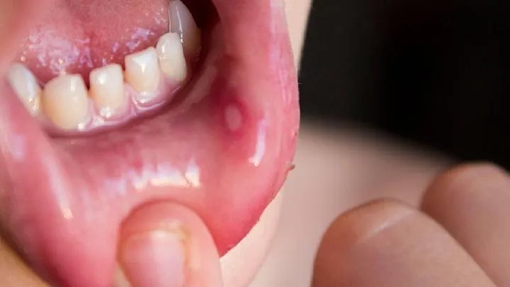 口腔溃疡的科学食疗方法是什么呢