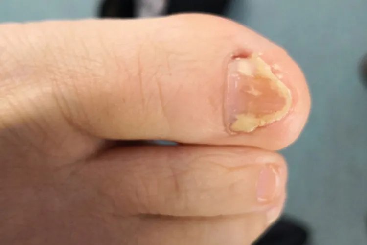 癣的种类与辨别图片