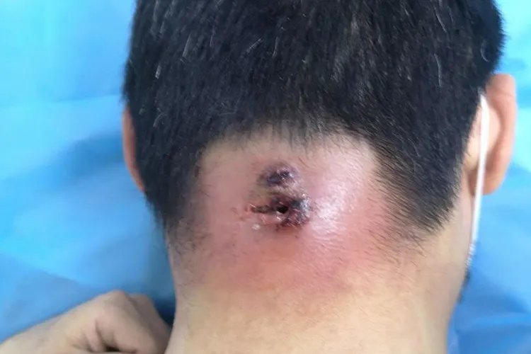 颈部长个包图片