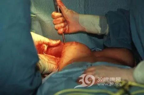 美女“隆胸手术”全程实录(组图)