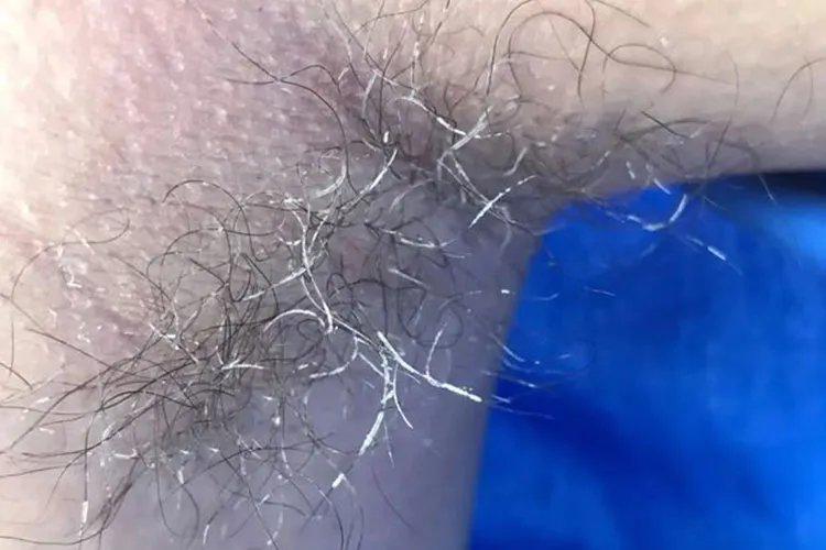 腋毛癣图片