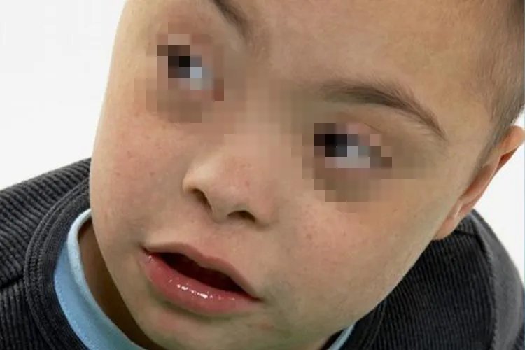 唐氏儿是什么样子图片