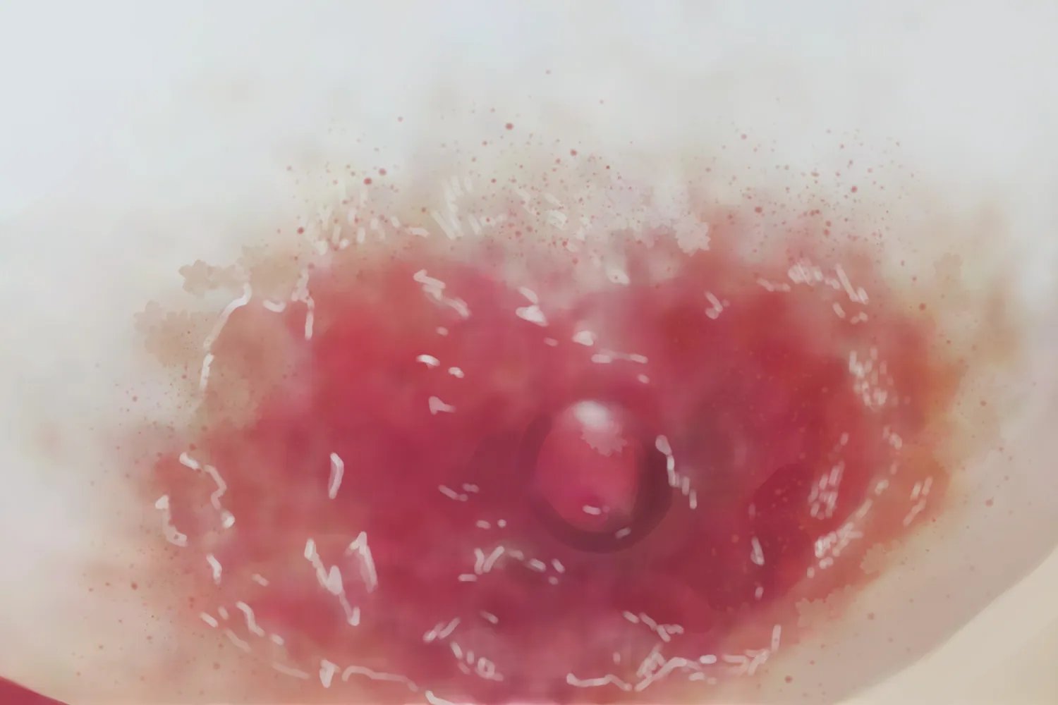 湿疹样癌乳晕症状图片