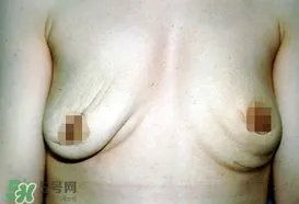 假体隆胸取出后悔死了 假体隆胸取出后图片