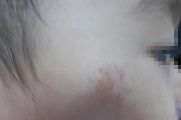 血管瘤图片