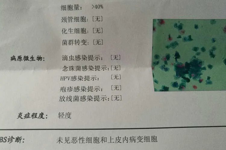 TCT检查结果正常图