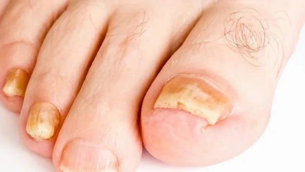 脚趾甲变厚发黄是怎么回事