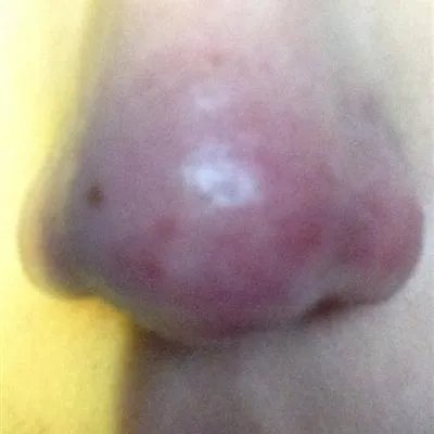 鼻出血怎么回事?