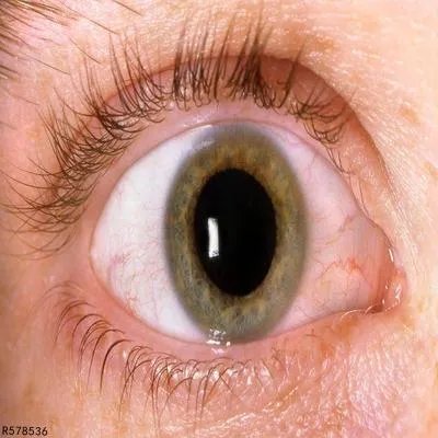 疱疹病毒性角膜炎怎么办