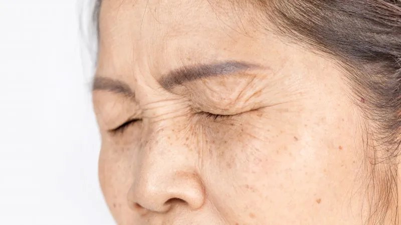 扁平疣和老年斑的区别有哪些,平时如何抑制老年斑的形成?