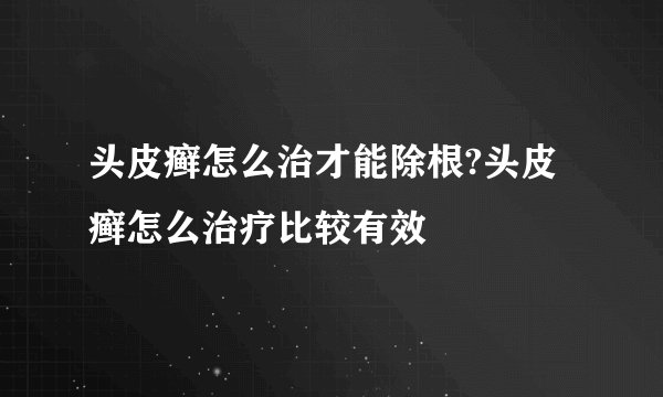 头皮癣怎么治才能除根?头皮癣怎么治疗比较有效